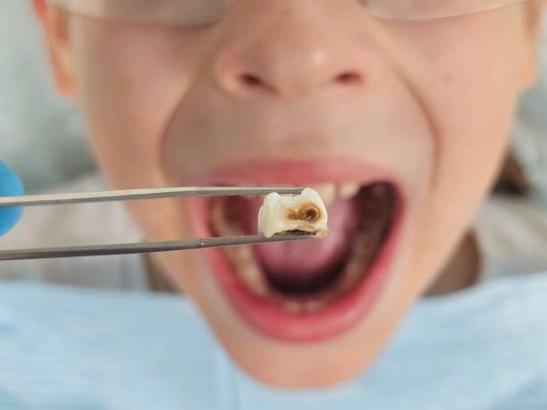 Best Emergency Wisdom Tooth Extraction in Abbeville, SC